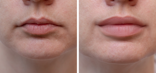 Vancouver dermal fillers lips