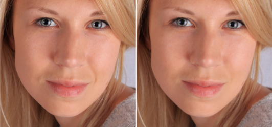 botox Vancouver 2 Kamani