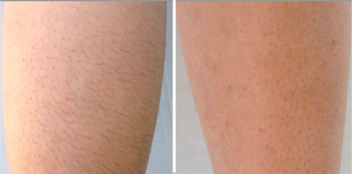 laser hair removal Vancouver DiolazeXL Vancouver